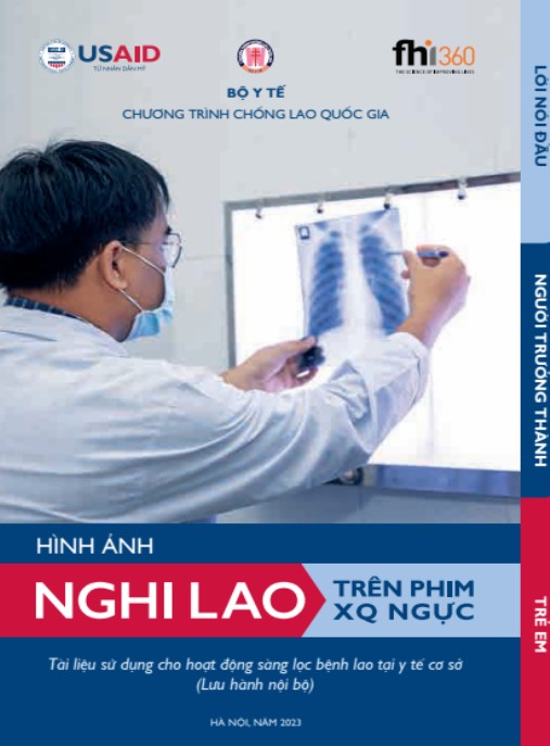 Hình Ảnh Nghi Lao Trên Phim XQ Ngực – Hướng Dẫn Chẩn Đoán Chuẩn Xác