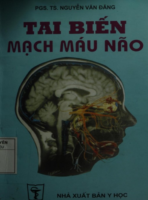 Tai Biến Mạch Máu Não – Bí Quyết Phòng Ngừa Và Điều Trị Hiệu Quả